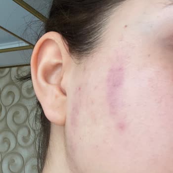 Aksis Premium Güzellik Merkezinde Yüzde Morluk Ve Hijyen İhlali