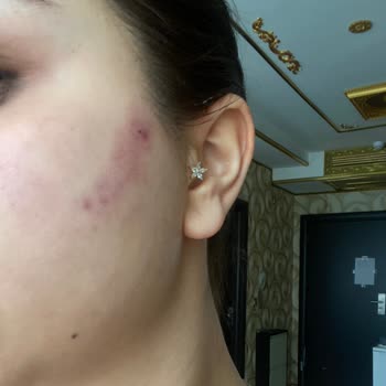 Aksis Premium Güzellik Merkezinde Yüzde Morluk Ve Hijyen İhlali