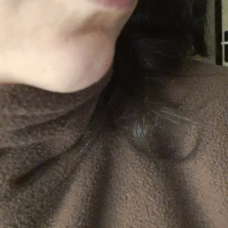 Kampanyalı Dudak Dolgusu Sonrası Asimetri, Ek Ücret İsteği Ve Hijyen Dışı Teklif