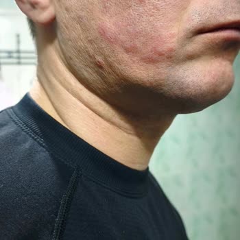 Zero Pore Ürünü Ciltte Şiddetli Alerji Ve Sivilcelenmeye Yol Açtı, İade Talebi