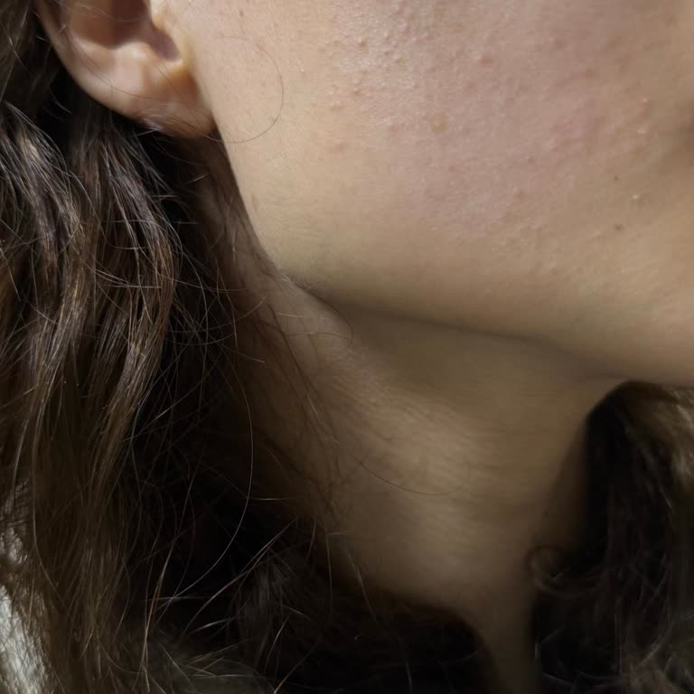 Braun FaceSpa 810 Kullanım Sonrası Ciltte Kabarcık Oluşması Ve İade Reddi