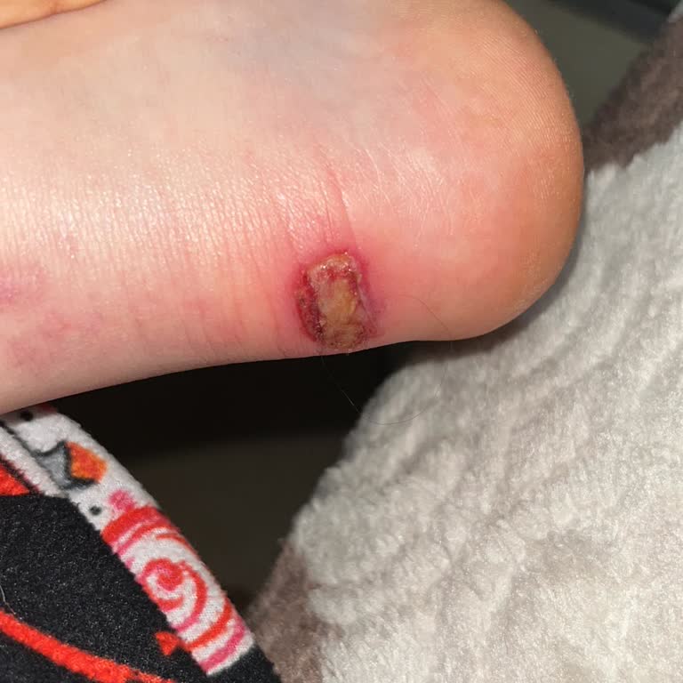 Orijinal Ayakkabı Ayak İltihabına Neden Oldu Hastaneye Başvuruldu