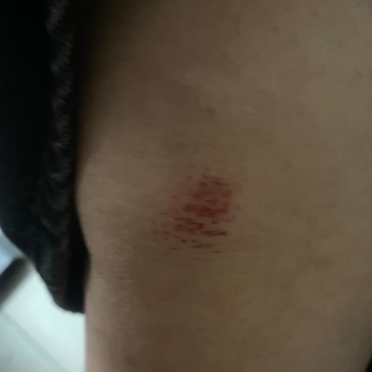 Kumaş Tüylenmesi Ve Cilt Tahrişi Nedeniyle İade Reddi