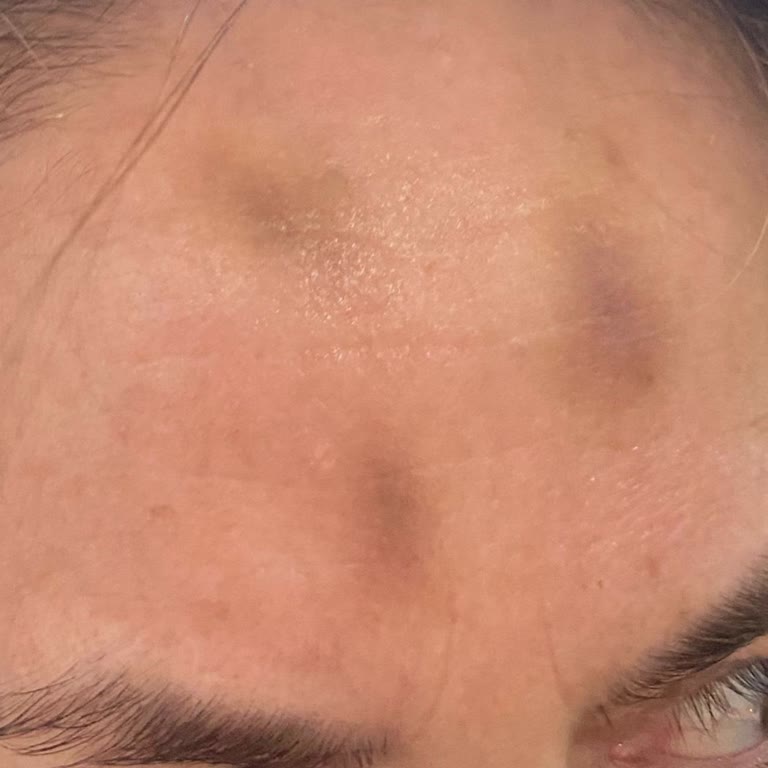 Bursa İcon Güzellik Merkezinde Sağlık Sorunu Sonrası İade Talebi