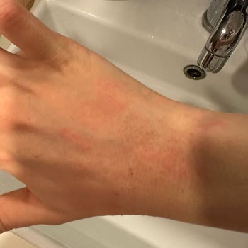 Barbaris Ürünlerinden Cilt Reaksiyonu Ve Ücret İadesi Talebi