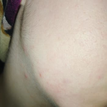 Neutrogena Peeling Jelinden Şiddetli Yanma Ve Yara Oluşumu