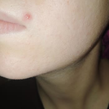 Neutrogena Peeling Jelinden Şiddetli Yanma Ve Yara Oluşumu