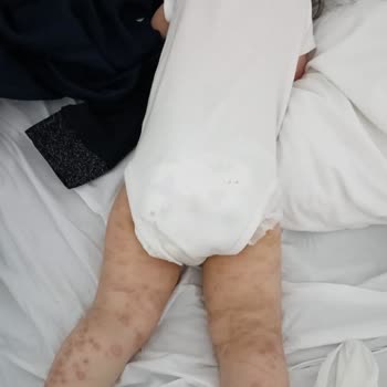 Yeni Med Tıp Merkezi’nde Klamoks İlacı Çocuğumun Hayatını Tehlikeye Attı