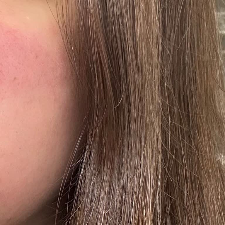 Brimoder Jel Kullanımından Şiddetli Kızarıklık Ve İade İsteği