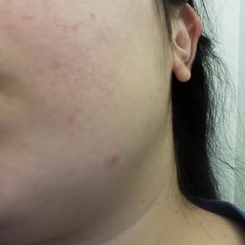 Elidor Pembe Şampuanı Ciltte Yanma Ve Sivilcelere Neden Oldu Müşteri Hizmetleri Cevap Vermedi