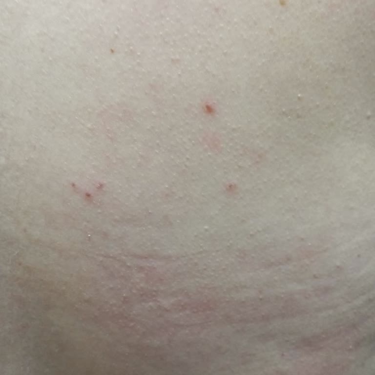 Hastane Odasında Böcek İstilası Ve Hijyen İhmali