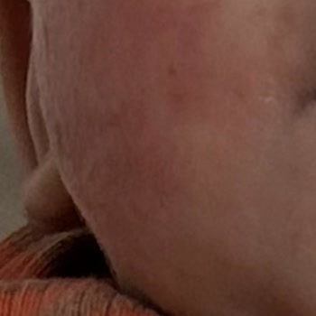 Mustela Stelatopia Intense Ürünü Bebek Cildinde Şiddetli Tahrişe Neden Oldu Ve İade Talep Ediliyor