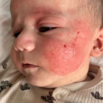 Mustela Stelatopia Intense Ürünü Bebek Cildinde Şiddetli Tahrişe Neden Oldu Ve İade Talep Ediliyor