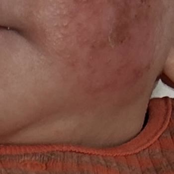 Mustela Stelatopia Intense Ürünü Bebek Cildinde Şiddetli Tahrişe Neden Oldu Ve İade Talep Ediliyor