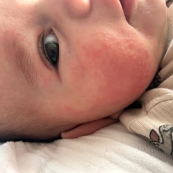 Mustela Stelatopia Intense Ürünü Bebek Cildinde Şiddetli Tahrişe Neden Oldu Ve İade Talep Ediliyor