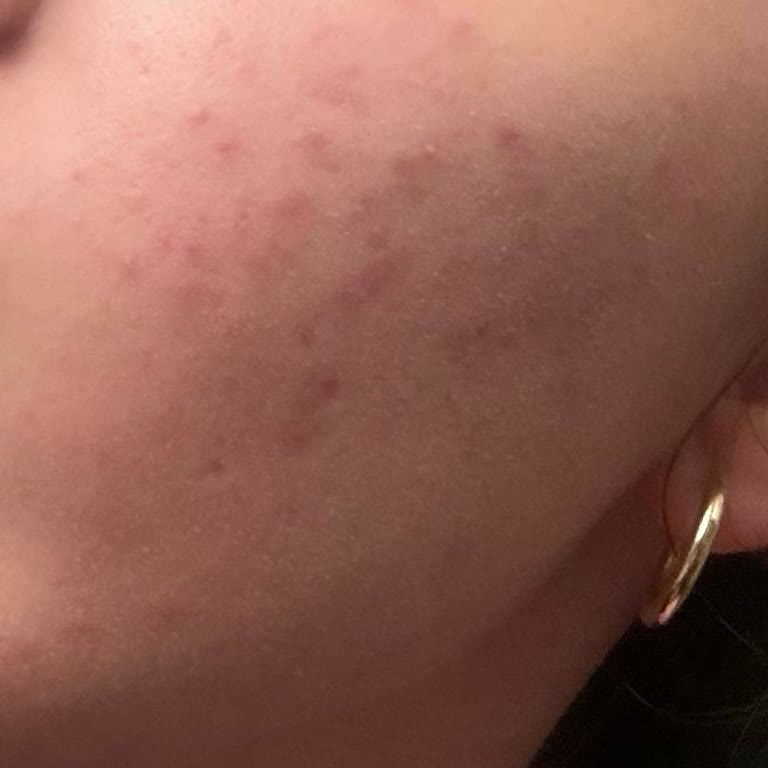 La Roche-Posay Cicaplast Krem Cildimde Şiddetli Yanma Ve Sivilce Oluşturdu