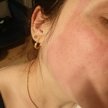 Isana Yüz Maskesi Uygulamasında Şiddetli Yanma Ve İade Talebi