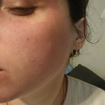 Isana Yüz Maskesi Uygulamasında Şiddetli Yanma Ve İade Talebi