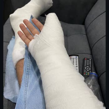 Asat’ın İçme Suyu Çalışması Sonrası Çukurlu Yolda Kaza Ve Alçıdaki Mağduriyet