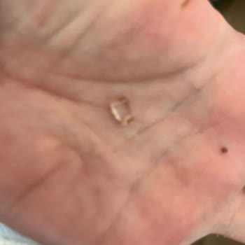 Yunus Market’te Şekerde Cam Parçası Bulunması Ve Ağız Yaralanması