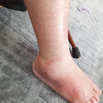 Kalp Kapakçığı Ameliyatı Sonrası Ayak Şişliği Ve Doktor İhmali