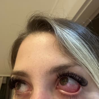 Kirpik İşlemi Sonrası Göz Enfeksiyonu Ve Ücret İadesi Reddi