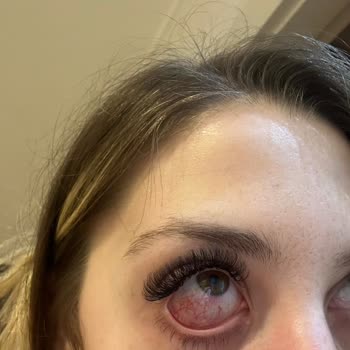 Kirpik İşlemi Sonrası Göz Enfeksiyonu Ve Ücret İadesi Reddi