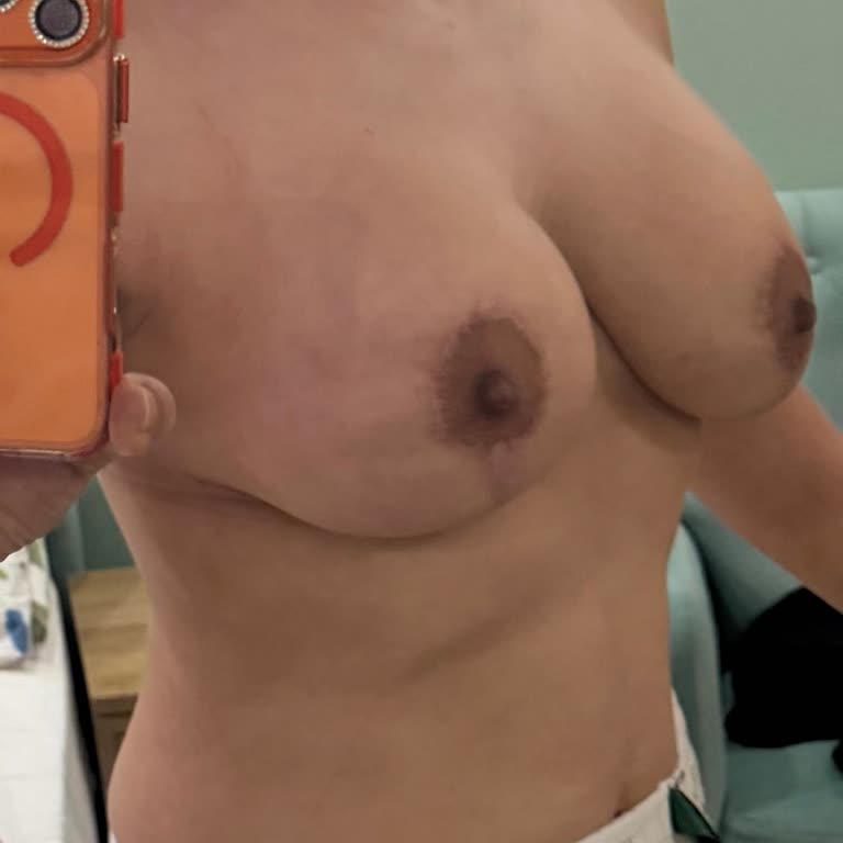 Başarısız Göğüs Toparlama Ameliyatı Sonrası İade Talebi Ve Maddi Manevi Zarar