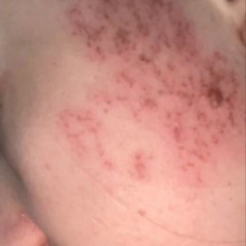 Epipera Şirinevler Şubesinde Hatalı Lazer İşlemi Sonrası Yanma Ve Geri Ödeme Talebi