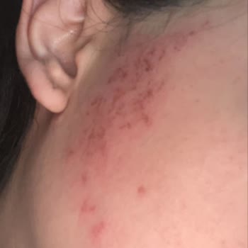 Epipera Şirinevler Şubesinde Hatalı Lazer İşlemi Sonrası Yanma Ve Geri Ödeme Talebi