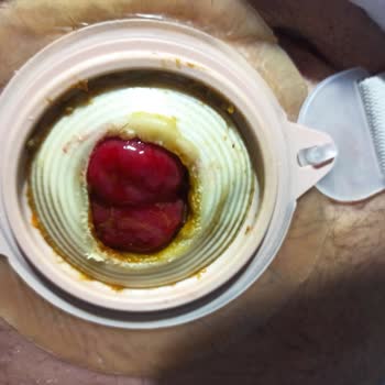 Coloplast Stoma Torbası Yapışma Ve Sızıntı Sorunları Ücret İadesi Talebi