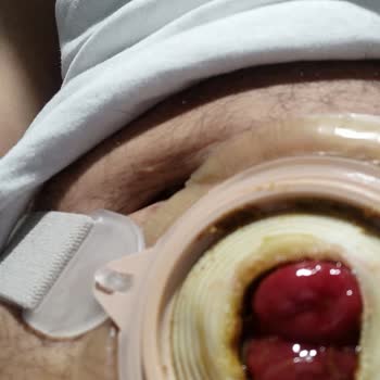 Coloplast Stoma Torbası Yapışma Ve Sızıntı Sorunları Ücret İadesi Talebi