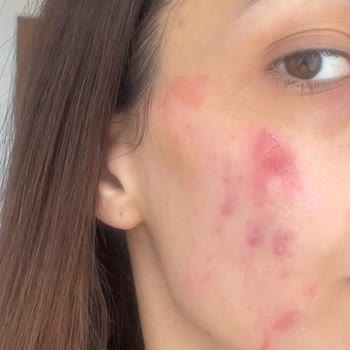 Yanık İzleri Ve Kalıcı Lekeler: 24 Bin TL İadesi Ve Tazminat Talebi