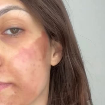 Yanık İzleri Ve Kalıcı Lekeler: 24 Bin TL İadesi Ve Tazminat Talebi