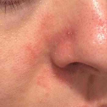 Bepanthol Derma Kreminde Şiddetli Hassasiyet Ve Kızarıklık