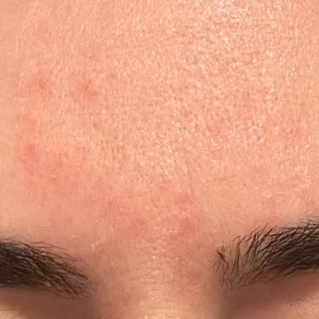 Bepanthol Derma Kreminde Şiddetli Hassasiyet Ve Kızarıklık