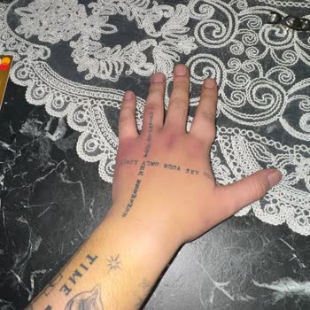 Yanlış Kan Alımı Sonrası Şiddetli El Şişliği Ve Ağrısı