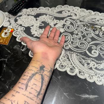 Yanlış Kan Alımı Sonrası Şiddetli El Şişliği Ve Ağrısı