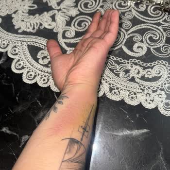 Yanlış Kan Alımı Sonrası Şiddetli El Şişliği Ve Ağrısı