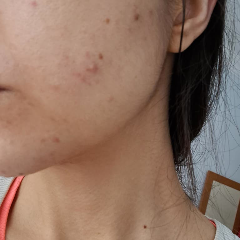 Bromelain Şurubu Yüzümde Akne Ve Kalıcı Lekeler Bıraktı