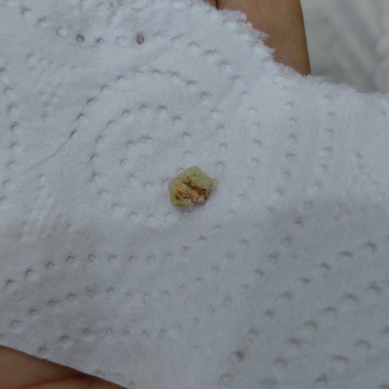 Algida Cornet Keyif Dondurmasında Taş Çıktı, Dişim Ağrıyor