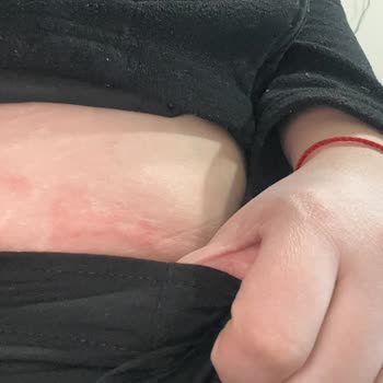Dermaelite Güzellik Merkezi Steril Olmayan Şartlarda Yüz Germe Ve Aşırı Ücretlendirme Şikayeti