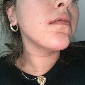 Dermaelite Güzellik Merkezi Steril Olmayan Şartlarda Yüz Germe Ve Aşırı Ücretlendirme Şikayeti