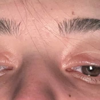 Dermaelite Güzellik Merkezi Steril Olmayan Şartlarda Yüz Germe Ve Aşırı Ücretlendirme Şikayeti