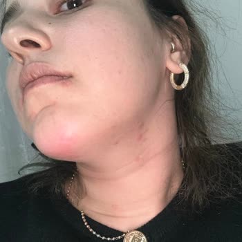 Dermaelite Güzellik Merkezi Steril Olmayan Şartlarda Yüz Germe Ve Aşırı Ücretlendirme Şikayeti