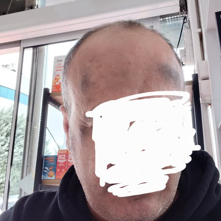 Özel Akademi Meram Hast. Hatalı Tedavi Sonrası Yanık İzli Yüz İçin Ücretsiz Lazer Tedavisi Talebi