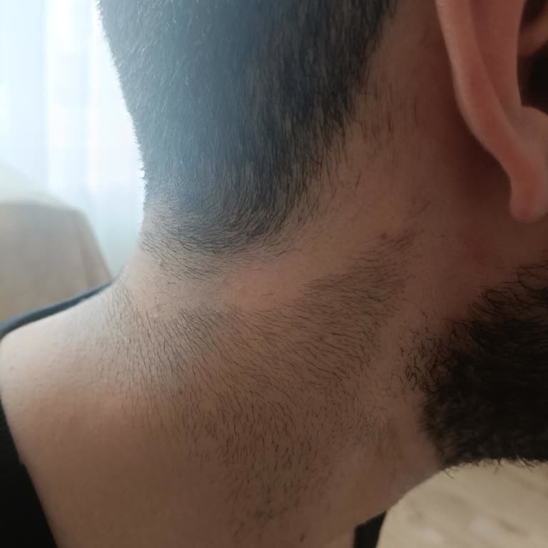 Beauty Boss Gebze Şubesinde Lazer Epilasyon Sonrası Kıllanma Ve Saç Dökülmesi Şikayeti