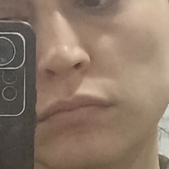 İzinsiz Golden İşlemi Sonrası Cilt Lekeleri Ve 160 Bin TL'lik Sözleşme İptali Talebi