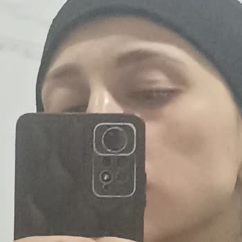 İzinsiz Golden İşlemi Sonrası Cilt Lekeleri Ve 160 Bin TL'lik Sözleşme İptali Talebi