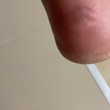 Lacoste Spor Ayakkabısında Şiddetli Ayak Ağrısı Ve Tırnak Kanaması